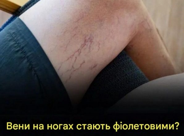Варикозне розширення вен на ногах може спричинити проблеми. Звідки беруться викривлені вени?